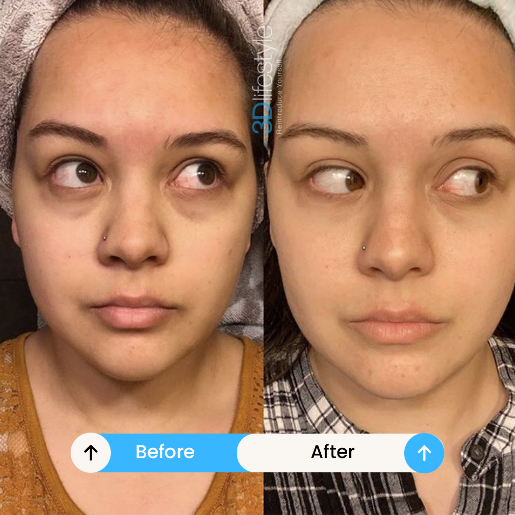 Dark Circle Treatment before .after....