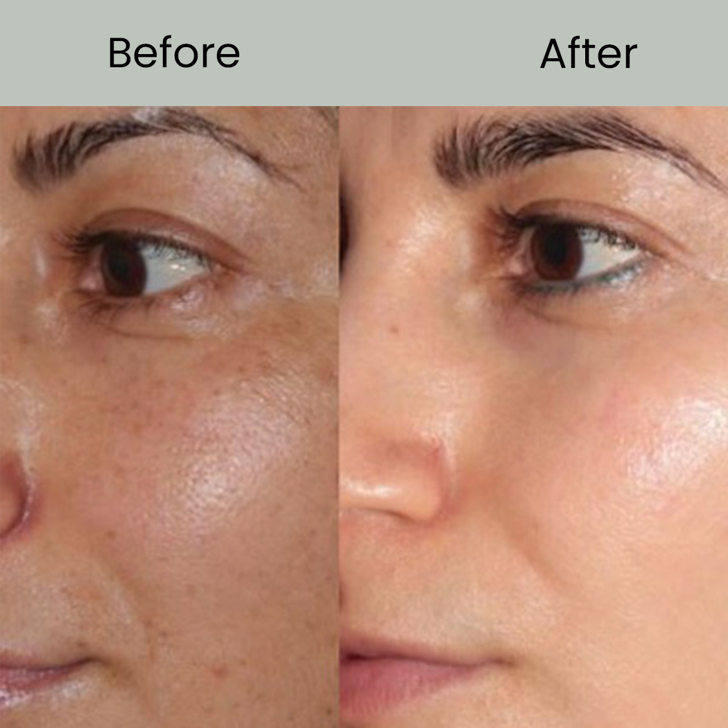 Glutathione Injection before after ...