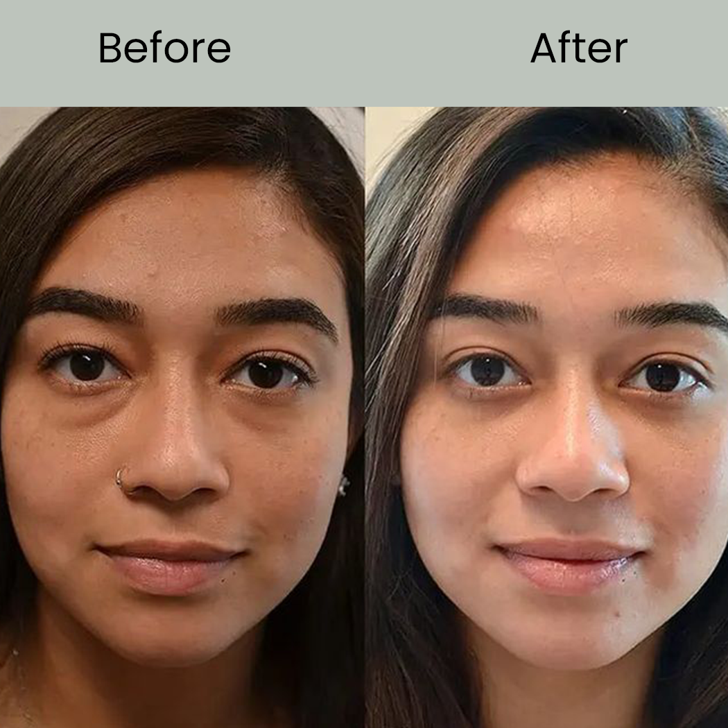 Glutathione Injection before after ......
