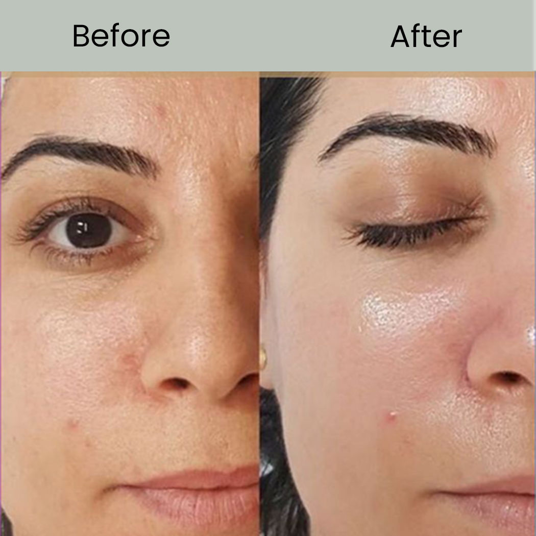Glutathione Injection before after