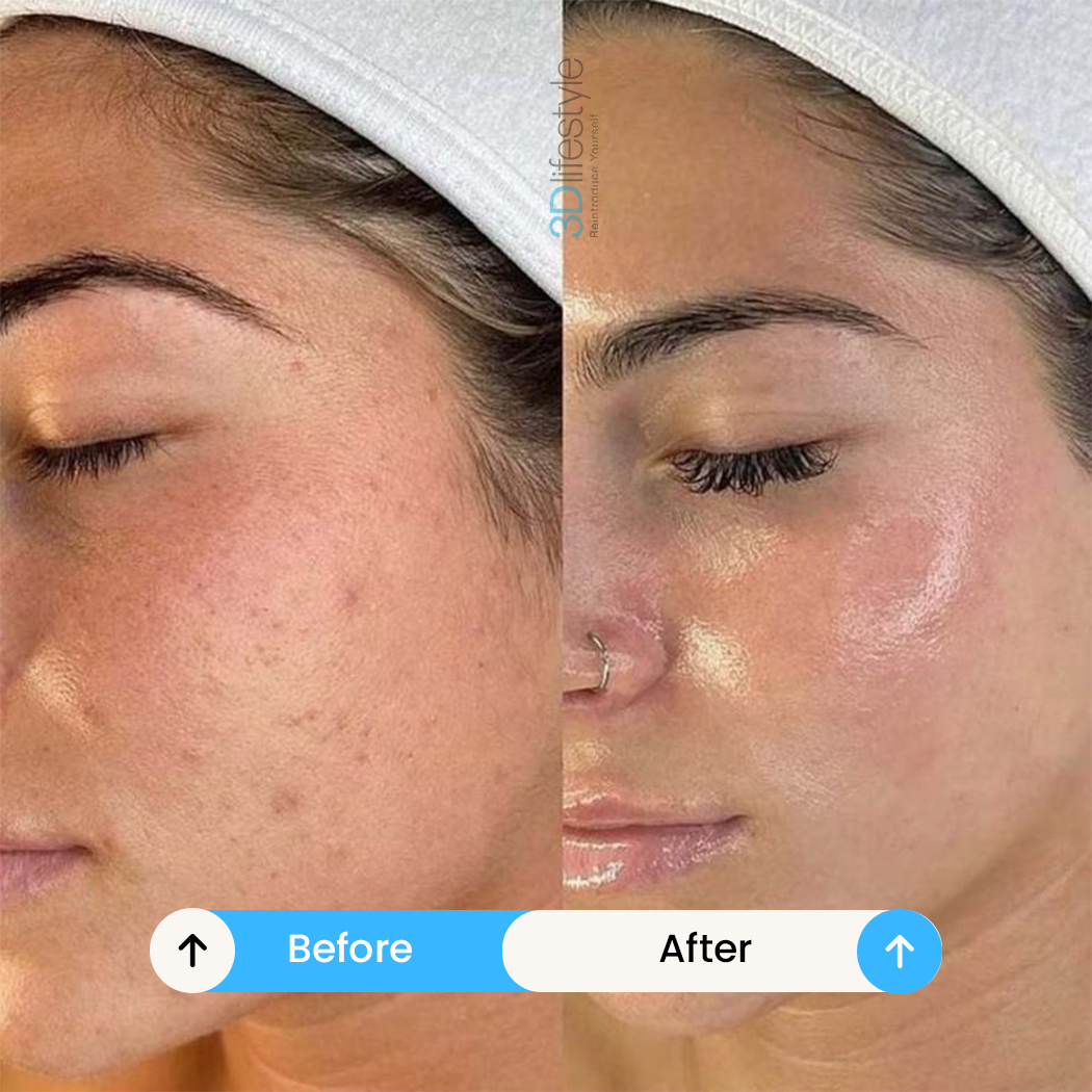 Hydra Facial before after