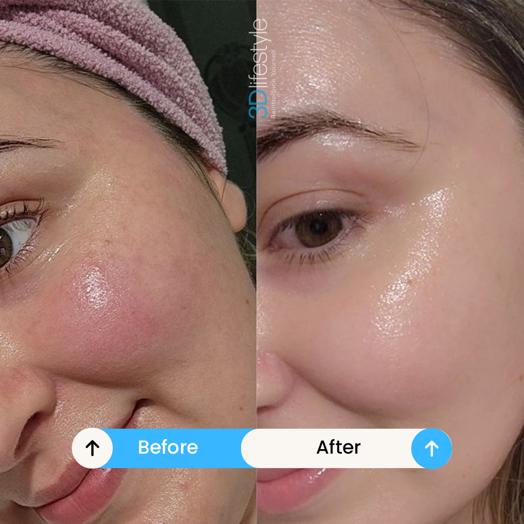 Hydra Facial before after..