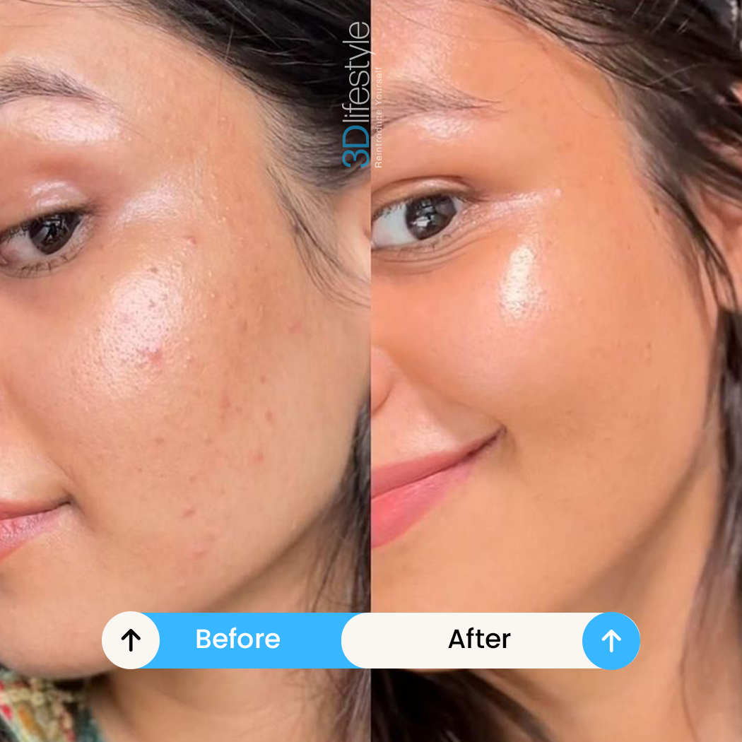 Hydra Facial before after....