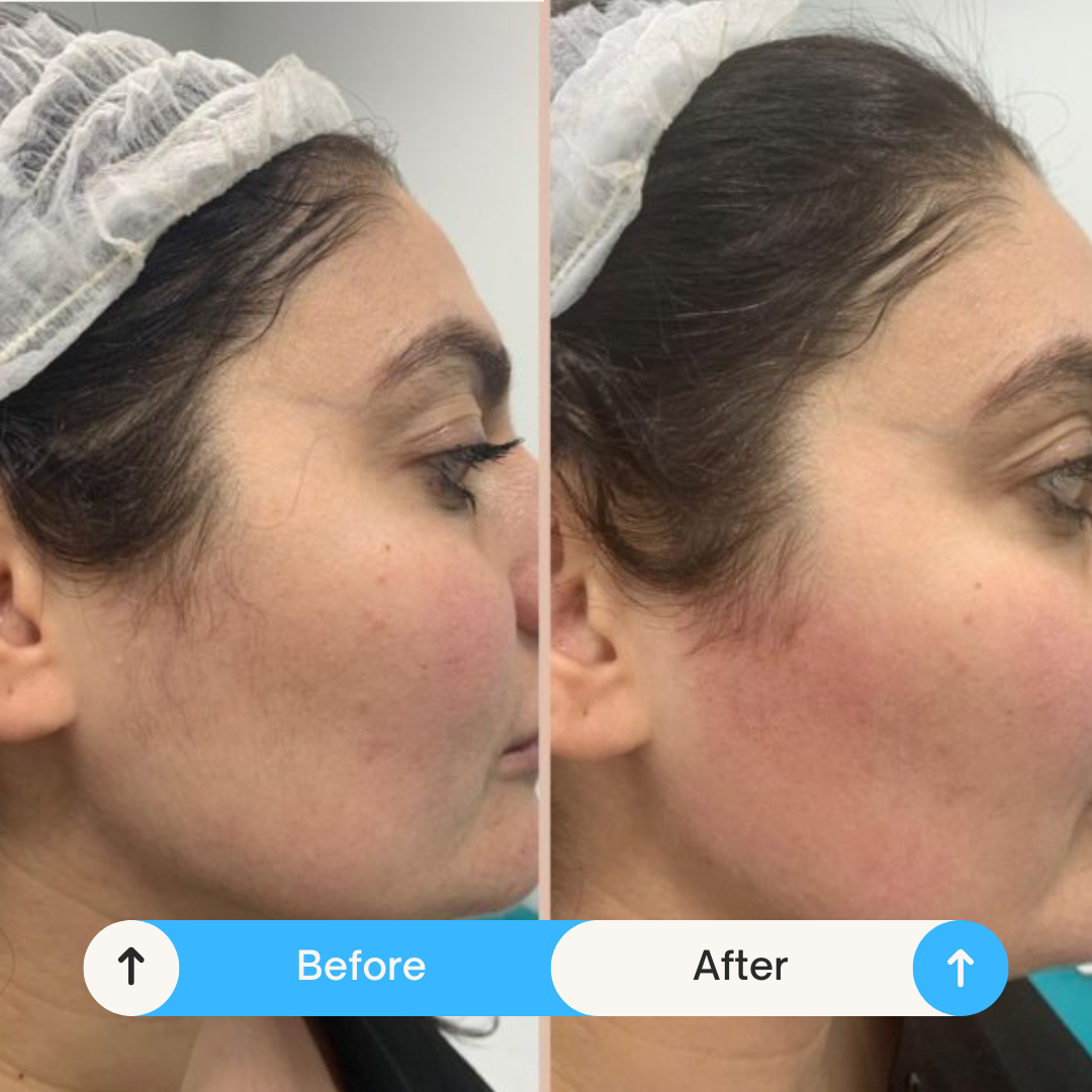 Laser Hair Removal Before After