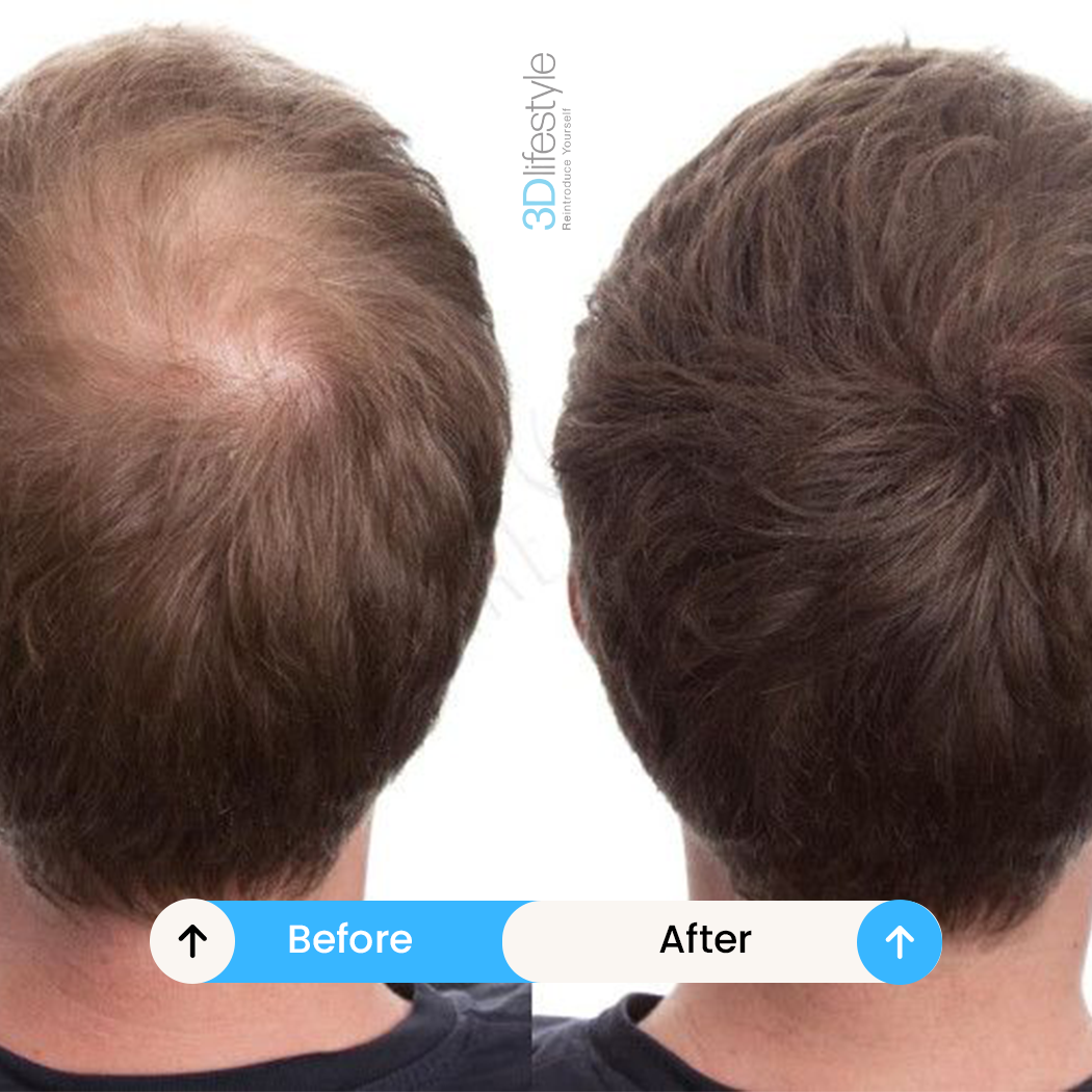 PRGF Hair before .after ..