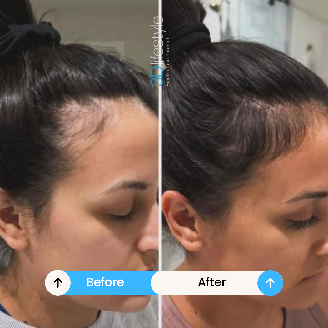 PRGF Hair before .after ..