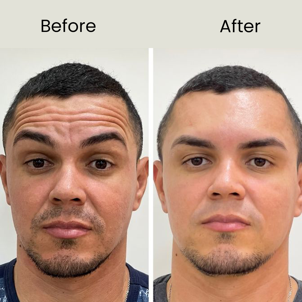 Skin Tightening before after ...