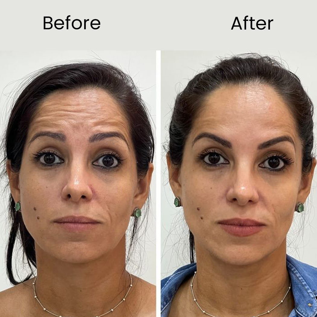Skin Tightening before after ......
