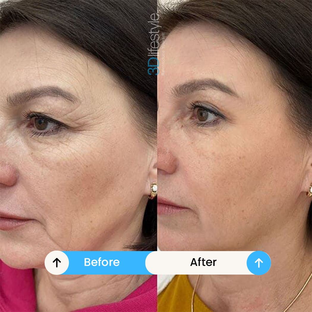 Skin Tightening before after .........
