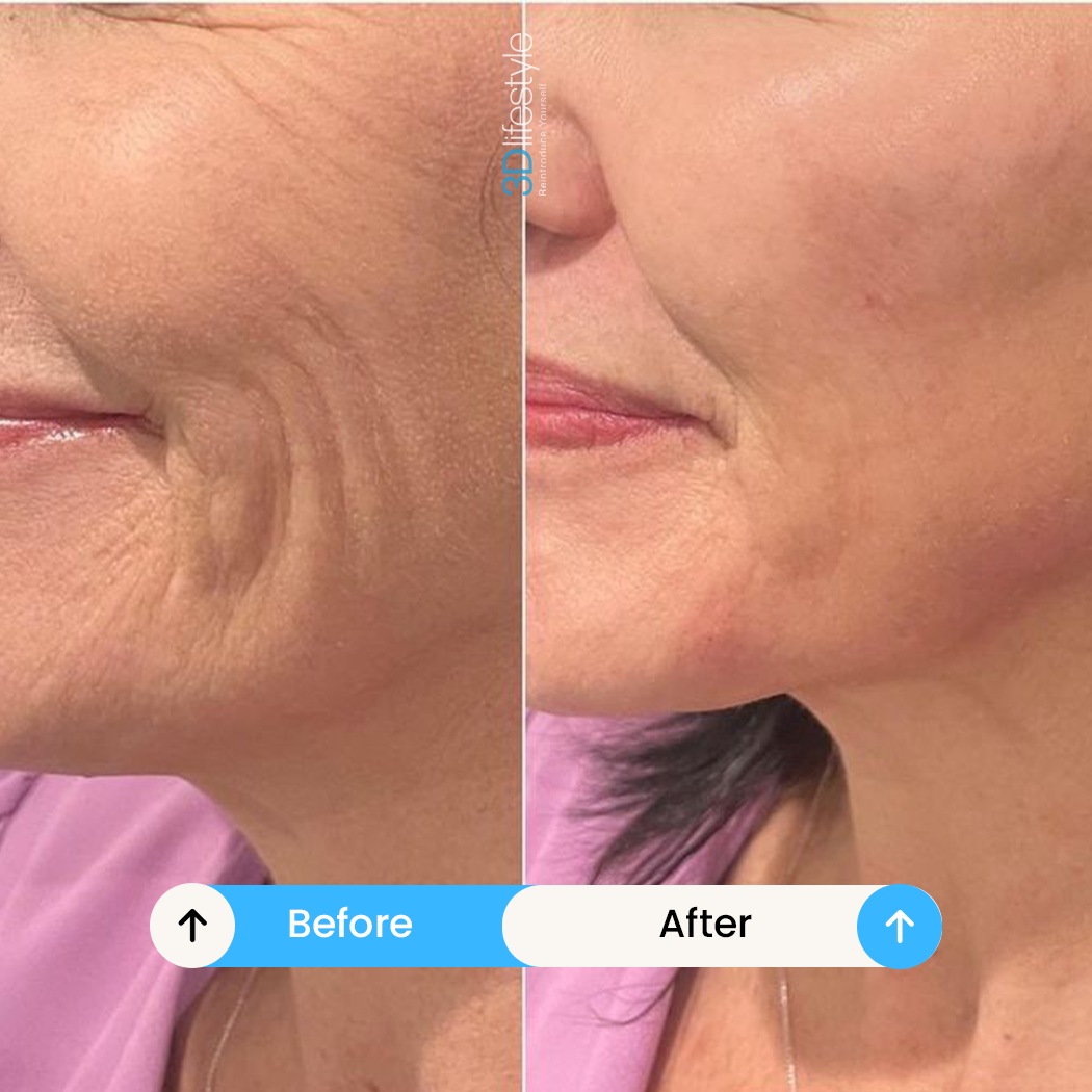 Skin Tightening before after ............
