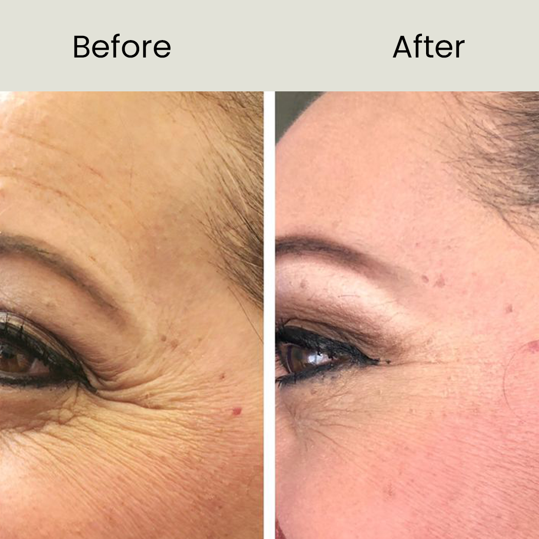 Skin Tightening before after