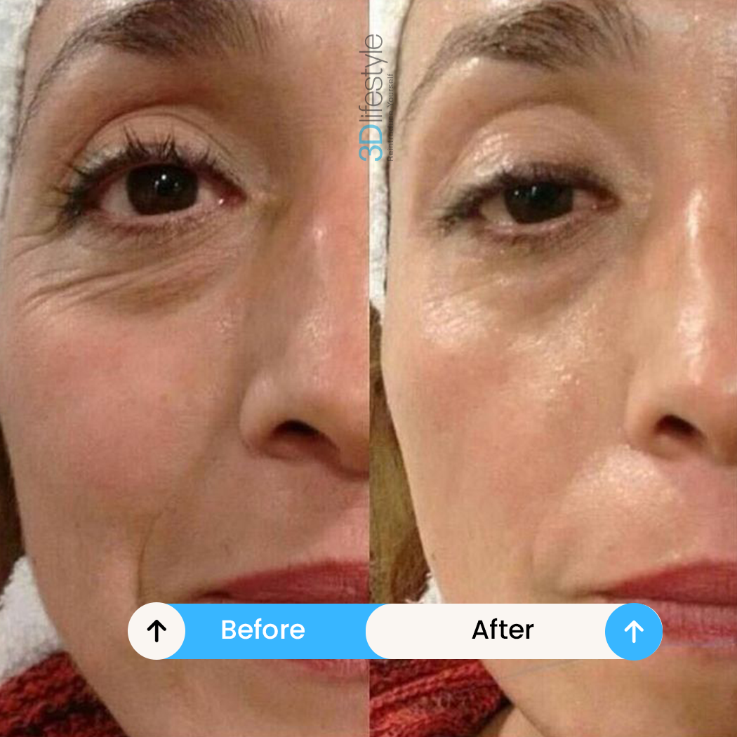 Skin Tightening before after...