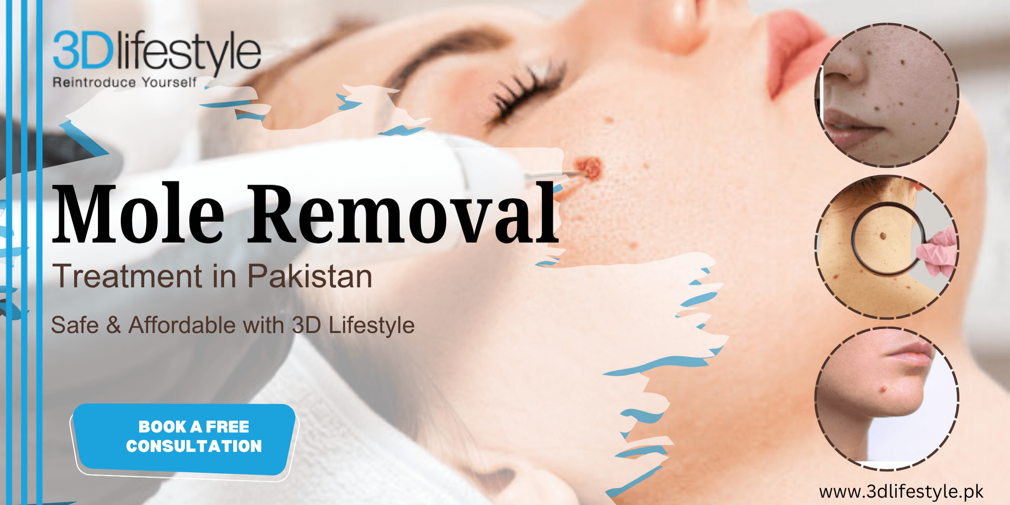 mole removal treatment