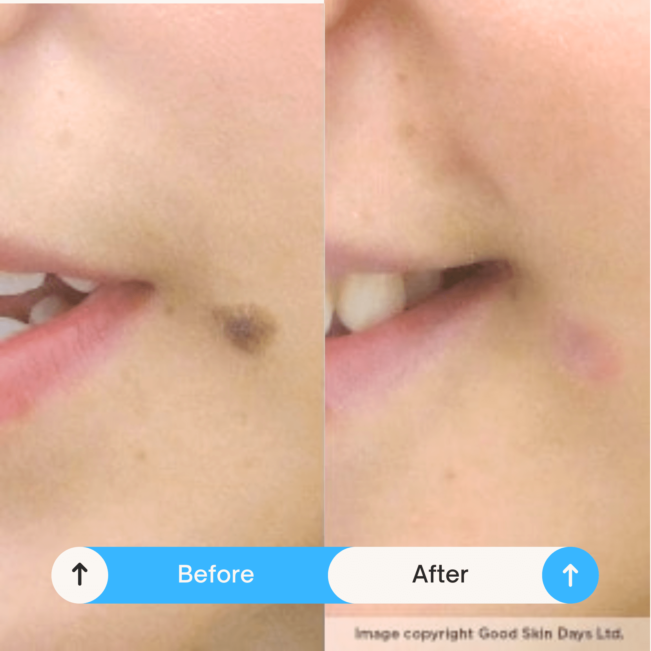 mole removals reatment