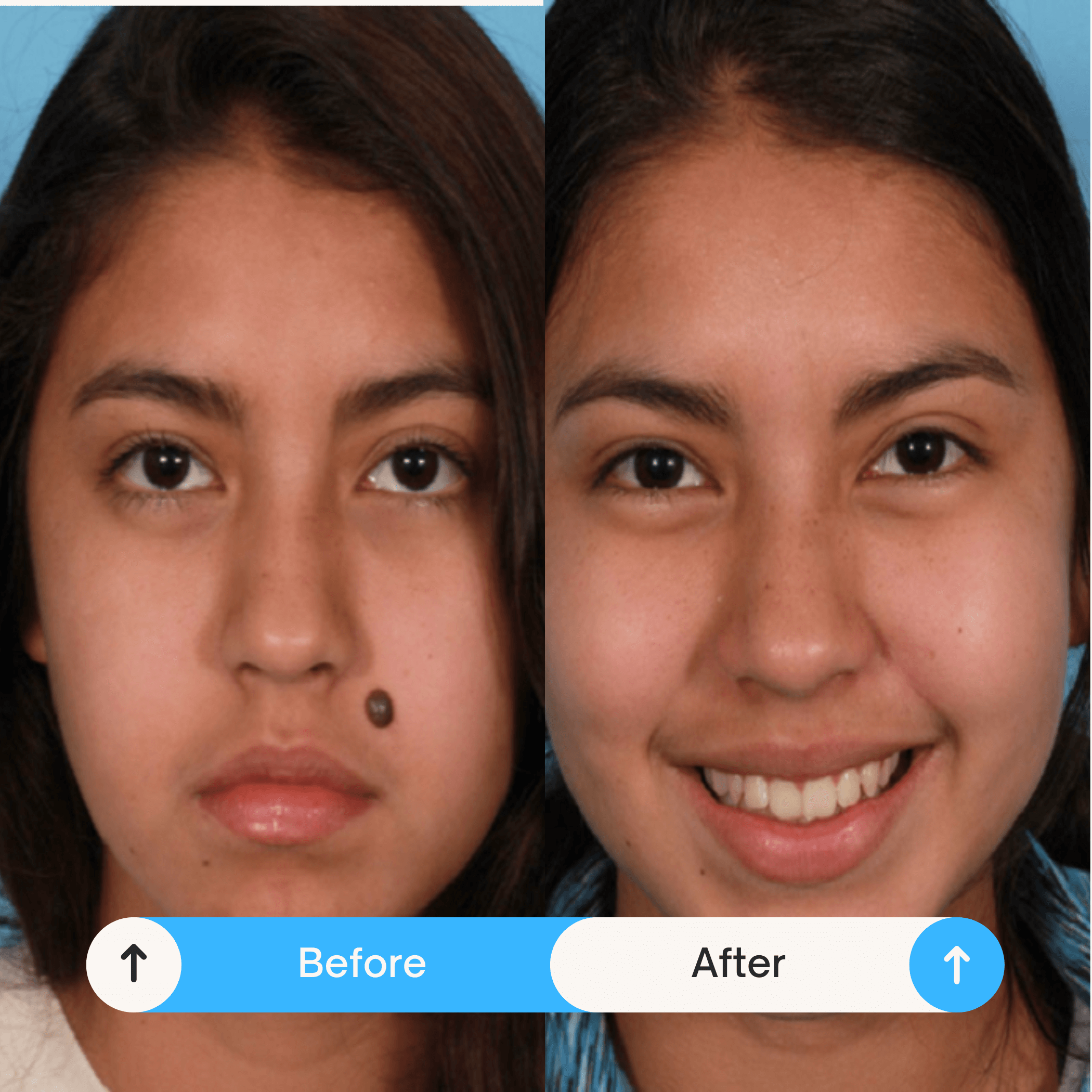 mole removals reatment