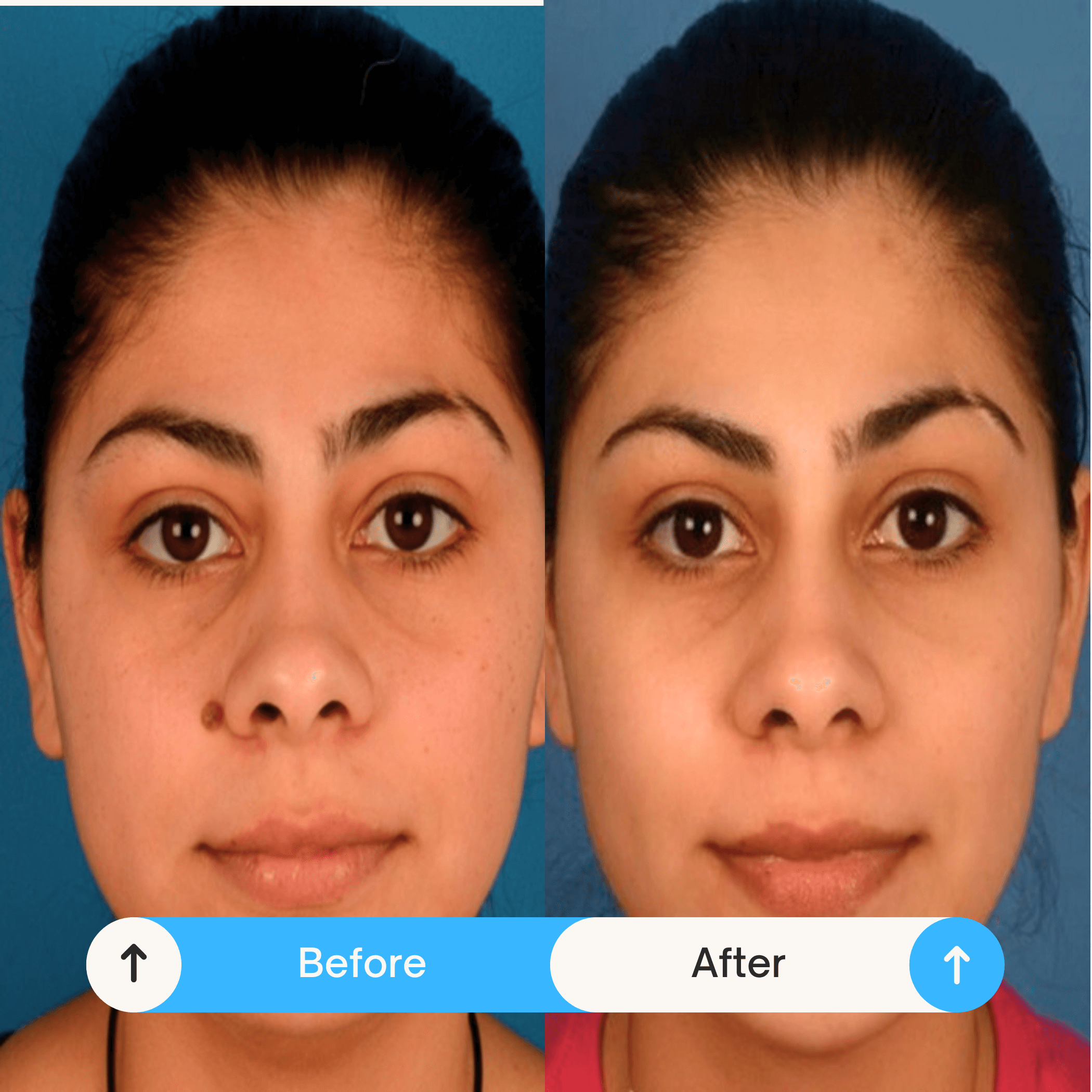 mole removals reatment