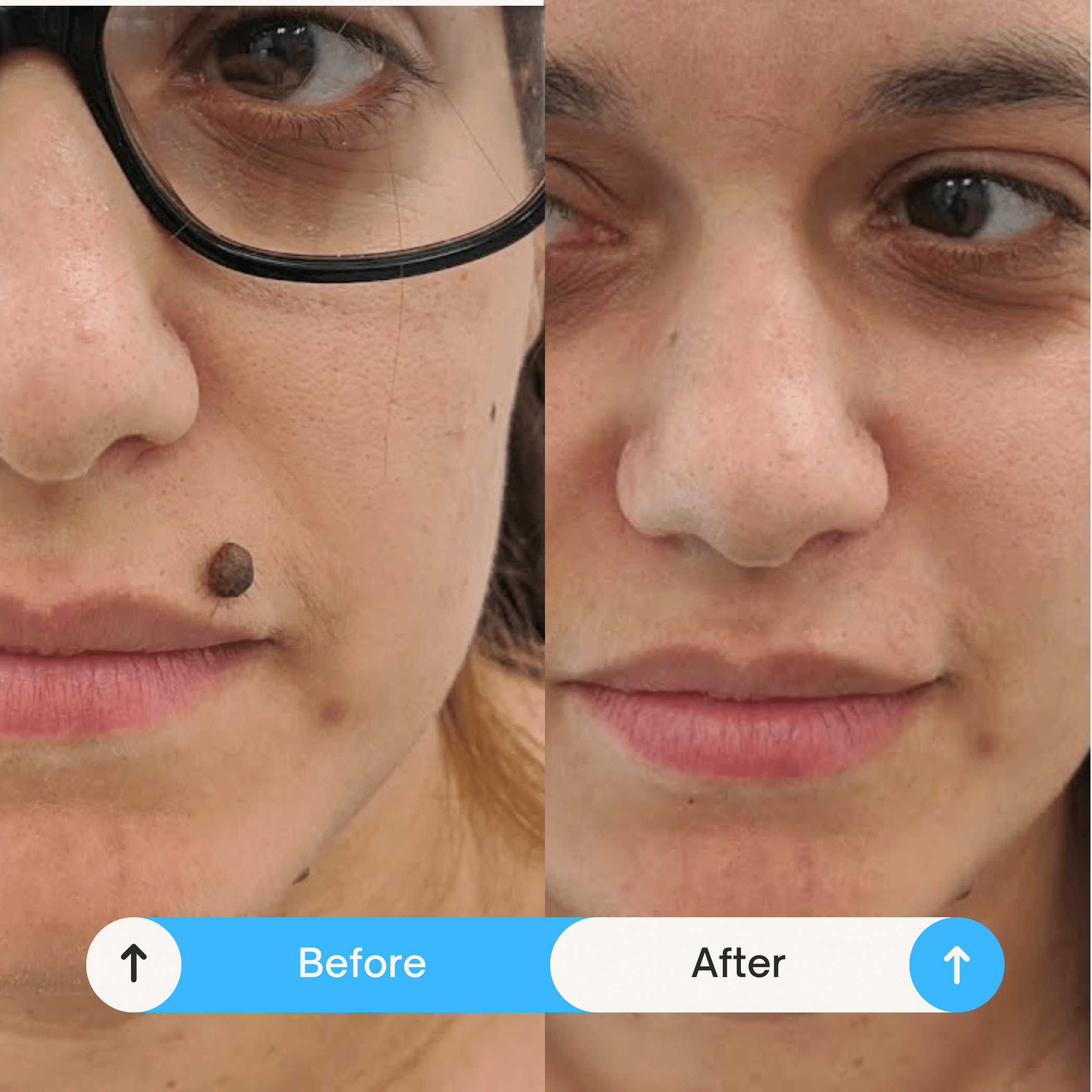 mole removals reatment