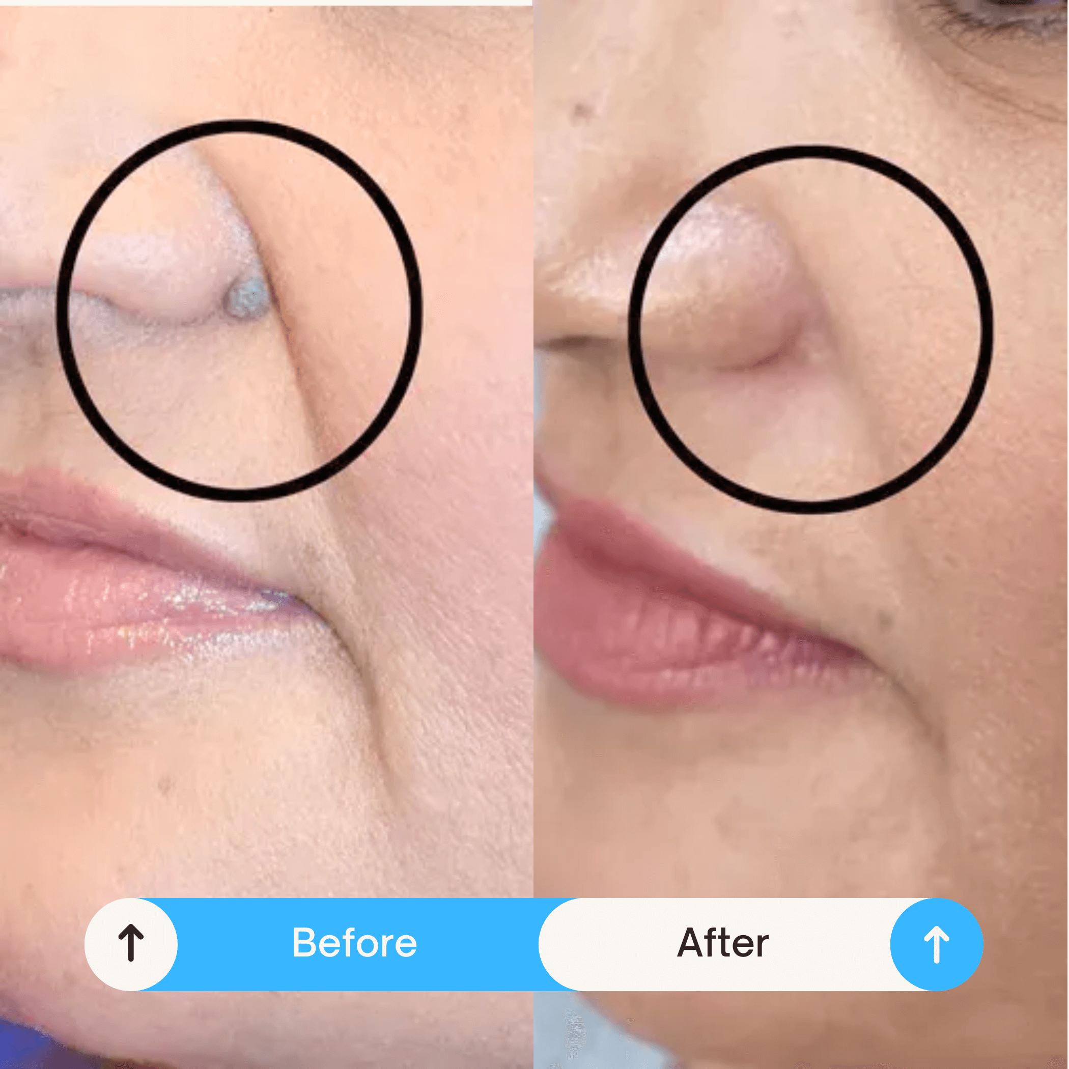 mole removals reatment5