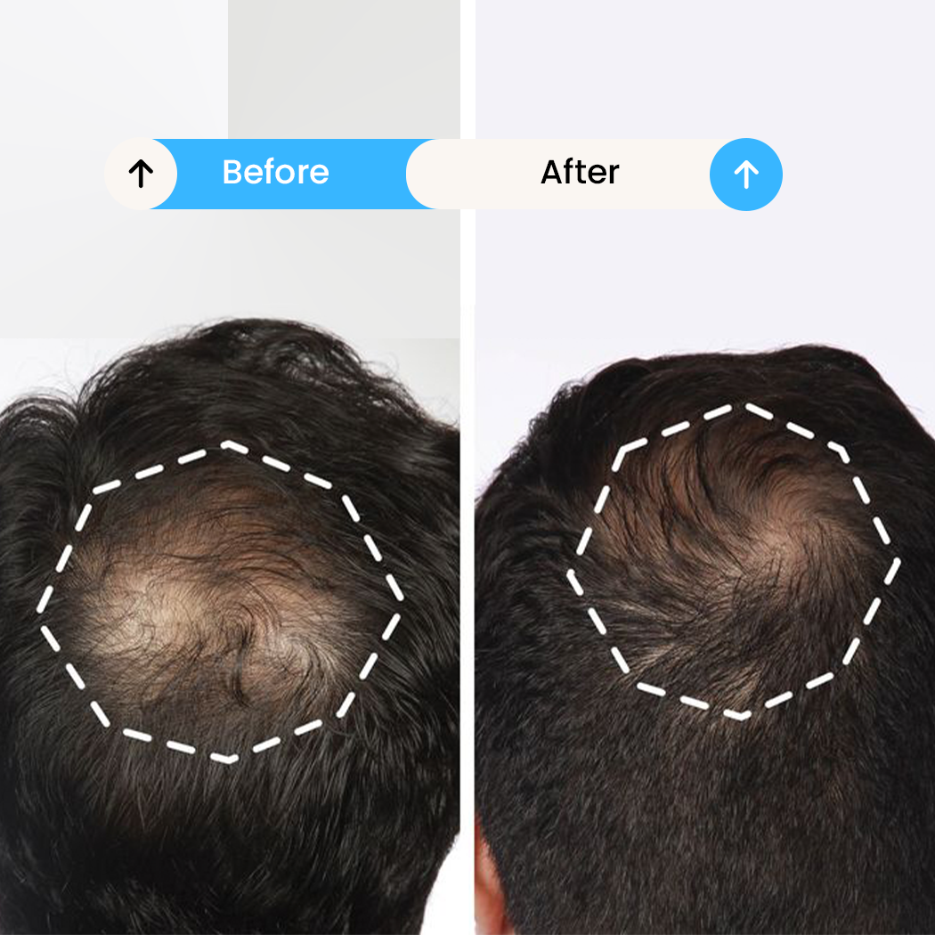 Exosomes for Hair Loss before after ..
