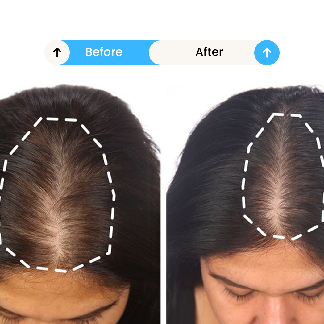Exosomes for Hair Loss before after