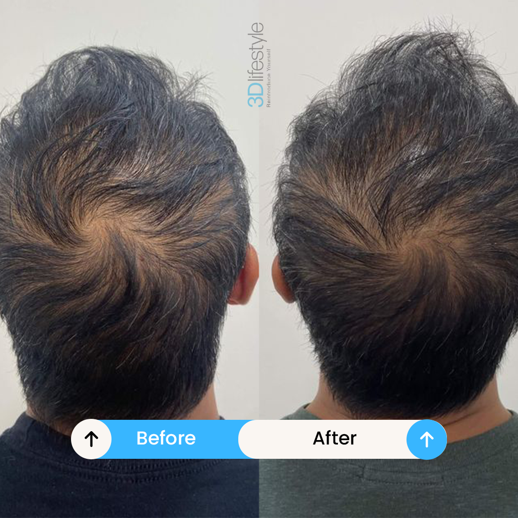 hair prp before .after