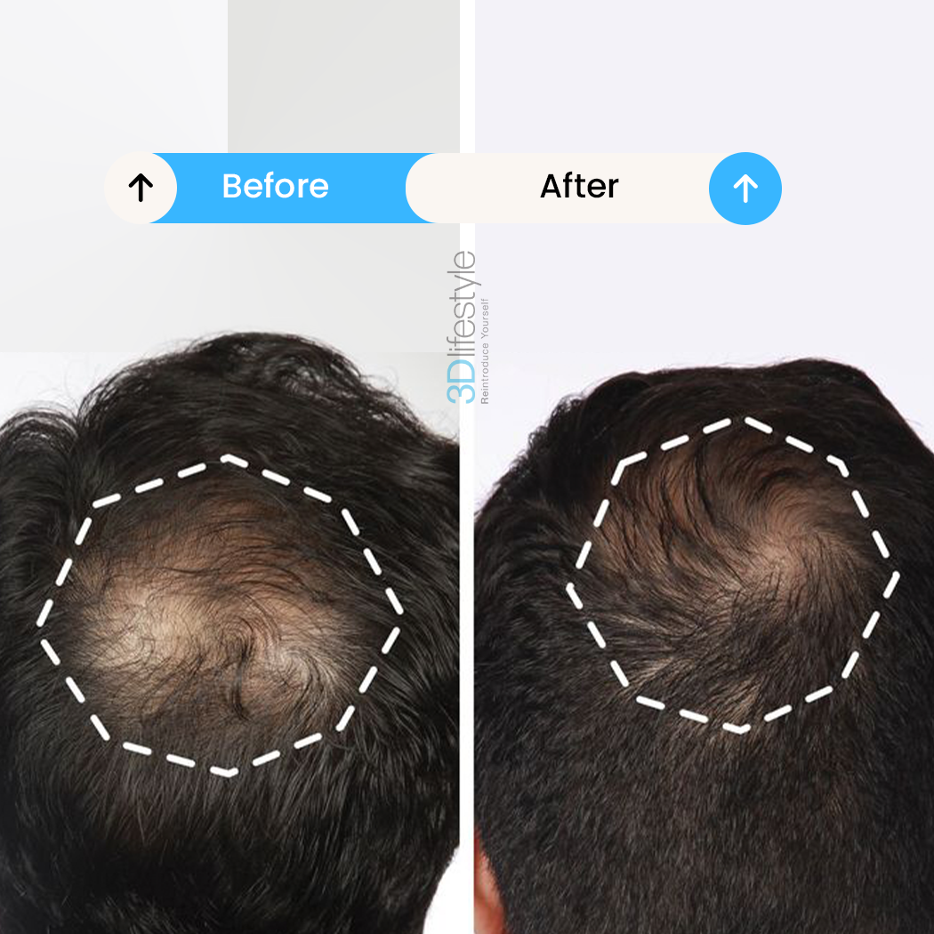 hair prp before .after..